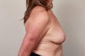 before breast reconstruction right side view case 2580