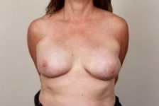 after breast reconstruction front view case 2580