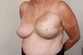 before breast reconstruction left angled view case 2587