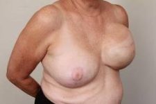 before breast reconstruction right angled view case 2587