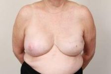 after breast reconstruction front view case 2587