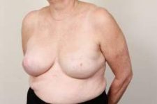 after breast reconstruction left angled view case 2587