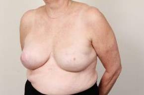 after breast reconstruction left angled view case 2587