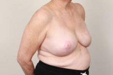 after breast reconstruction right angled view case 2587