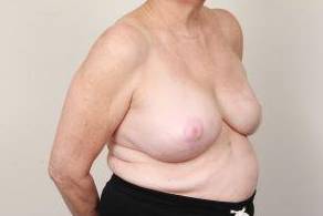 after breast reconstruction right angled view case 2587