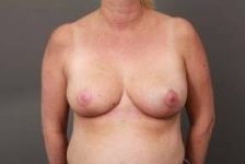 after breast reconstruction front view case 2601