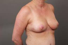 after breast reconstruction right angled view case 2601