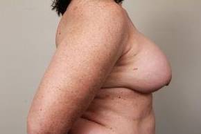 before breast reconstruction right side view case 2612