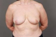 after breast reconstruction front view case 2612