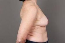 after breast reconstruction right side view case 2612