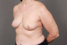 after breast reconstruction left angled view case 2612