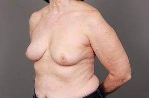 after breast reconstruction left angled view case 2612