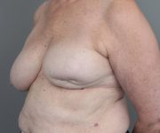 before breast reconstruction left angled view case 2619