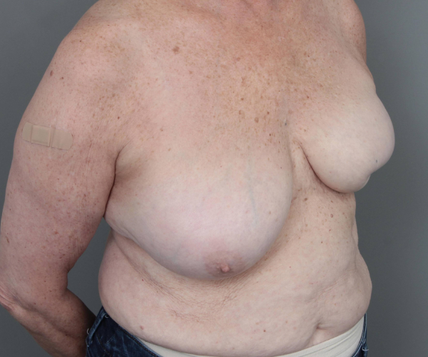 before breast reconstruction right angled view 2619