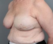 after breast reconstruction left angled view case 2619