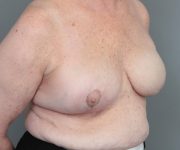 after breast reconstruction right angled view case 2619