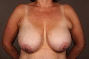 before breast reduction front view case 1754