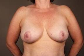 after breast reduction front view case 1754