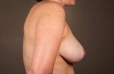 after breast reduction right side view case 1754