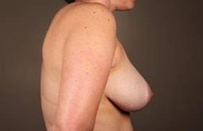 after breast reduction right side view case 1754