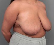 before breast reduction right angled view case 1761