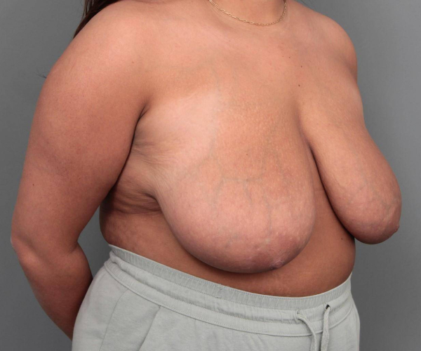 before breast reduction right angled view case 1761