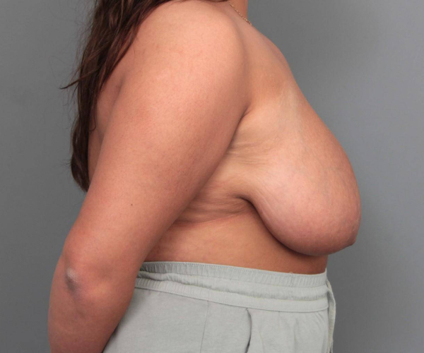 before breast reduction right side view case 1761