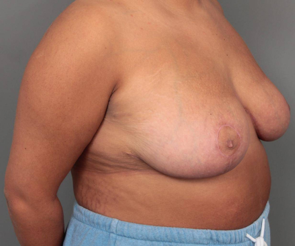 after breast reduction right angled view case 1761