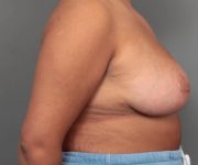 after breast reduction right side view case 1761