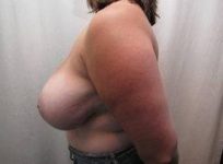 before breast reduction left side view case 1768