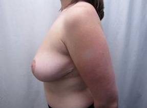 after breast reduction left side view case 1768