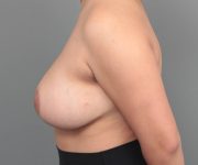 after breast reduction left side view case 1780