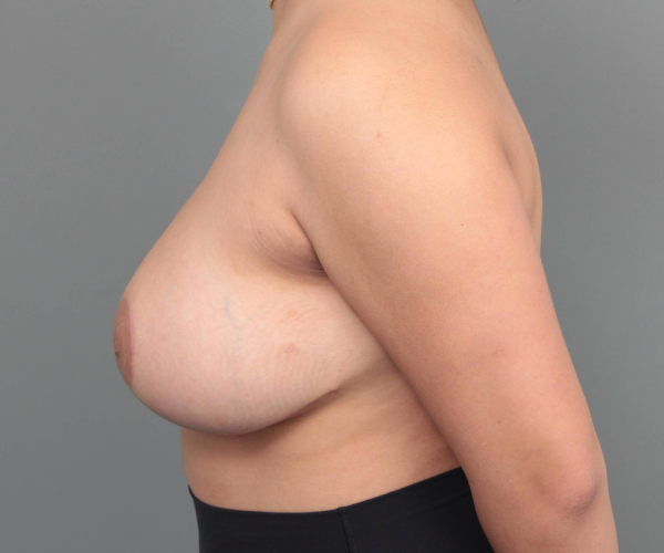 after breast reduction left side view case 1780