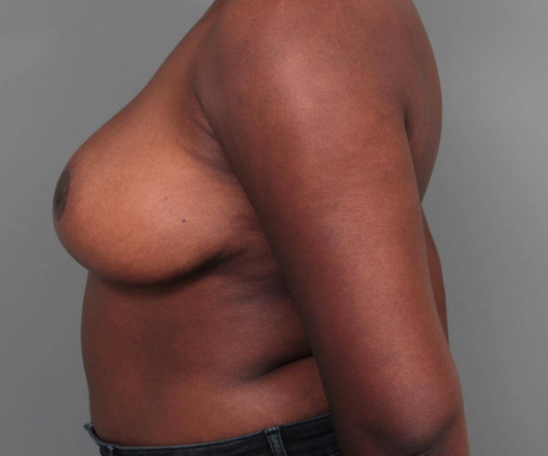 after breast reduction left side view case 1785