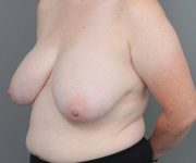 before breast reduction left angled view case 1792
