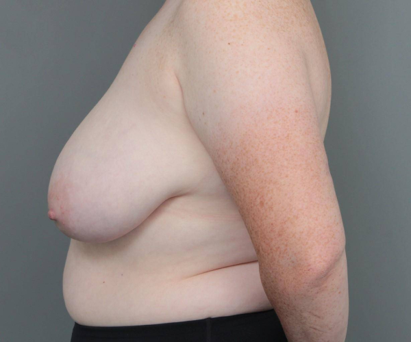 before breast reduction left side view case 1792