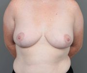 after breast reduction front view case 1792