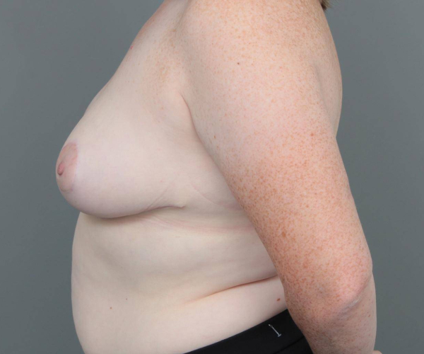 after breast reduction left side view case 1792