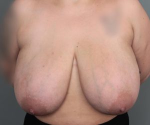 before breast reduction front view case 1805