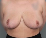 after breast reduction front view case 1805