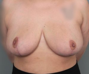after breast reduction front view case 1805