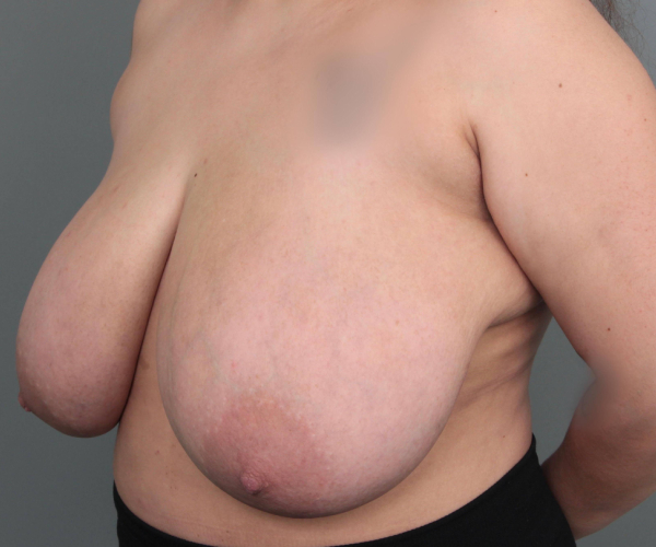 before breast reduction left angled view case 1805