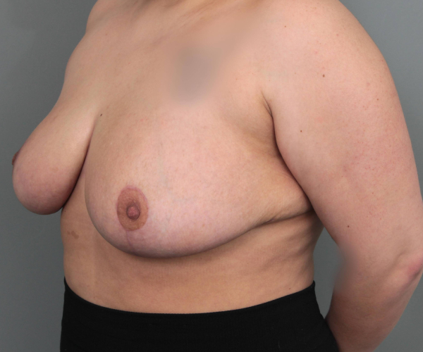 before breast reduction left angled view case 1805
