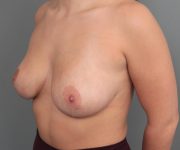 after breast reduction left angled view case 1810