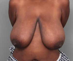 before breast reduction front view case 1818