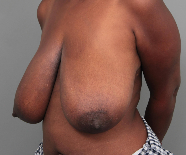 before breast reduction left angled view case 1818