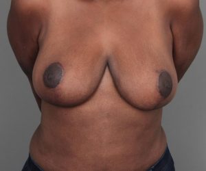 after breast reduction front view case 1818