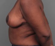 after breast reduction left side view case 1818