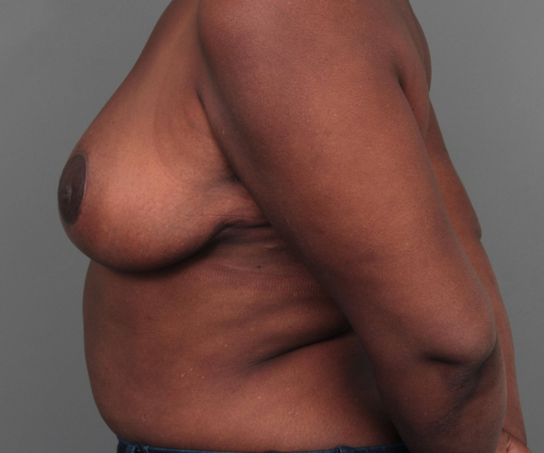 after breast reduction left side view case 1818