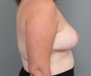after breast reduction right side view case 1832